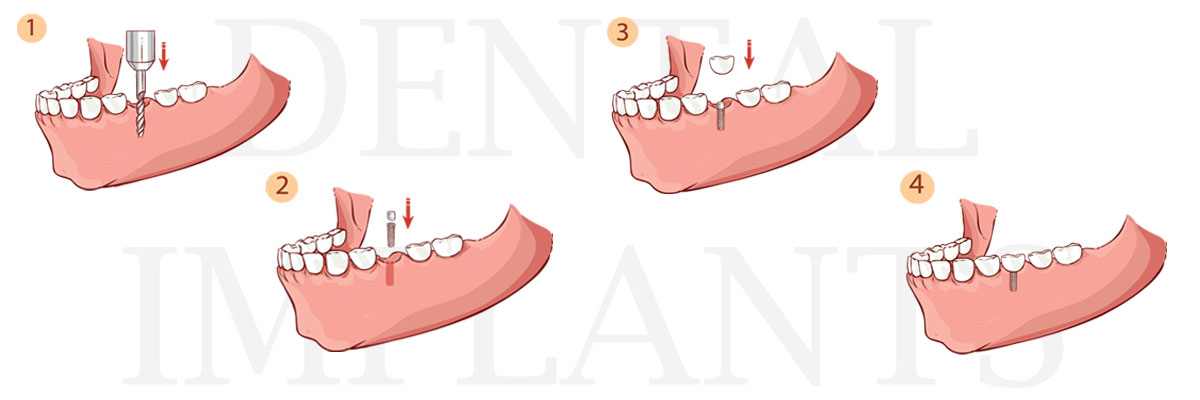Spokane The Difference Between Dental Implants and Mini Dental Implants