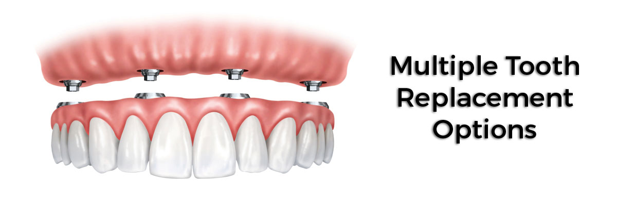 Spokane Multiple Teeth Replacement Options