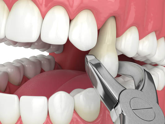 When Is Tooth Extraction Recommended?